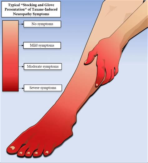 stocking glove syndrome|Peripheral Neuropathy: Causes, Types, Symptoms